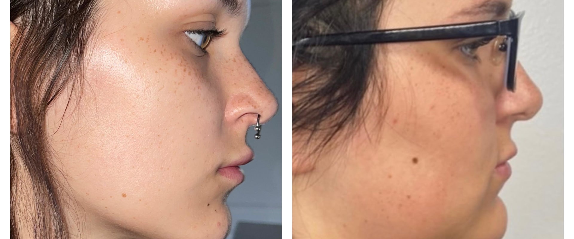 The Incredible Transformation: A Look at Kybella Before and After Photos