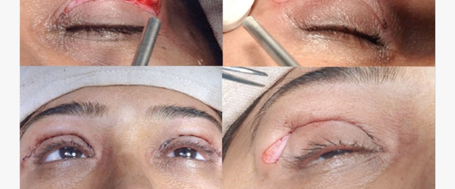 Everything You Need to Know About Eyelid Surgery