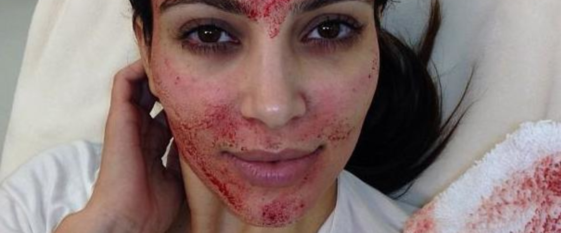 Everything You Need to Know About Vampire Facials