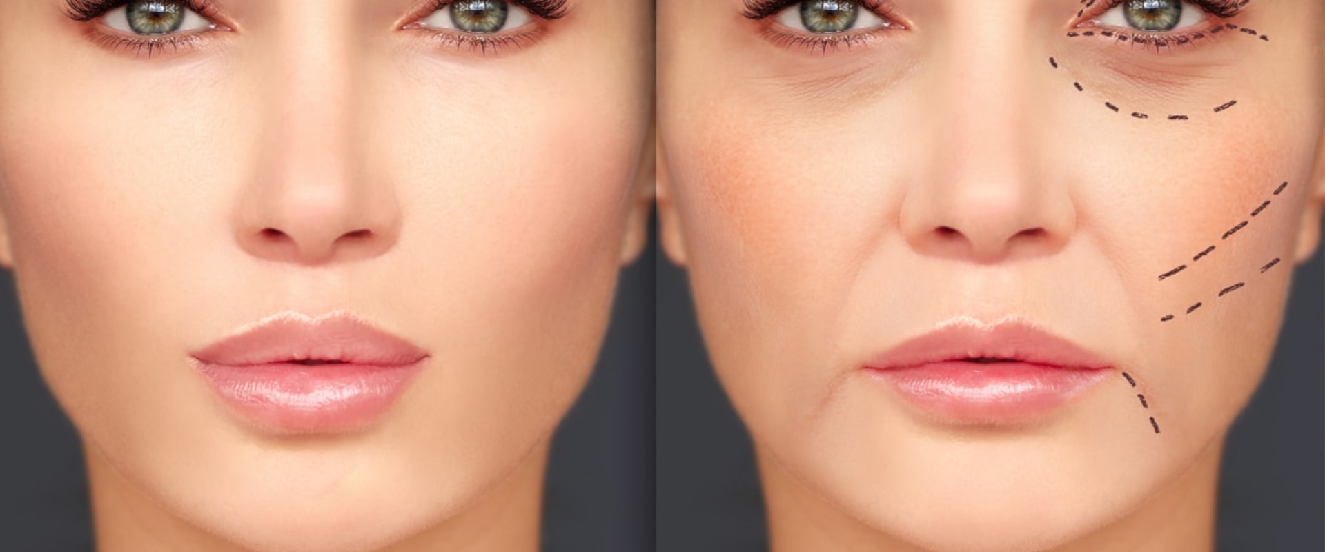 Dermal Fillers Before and After: What You Need to Know