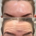 All You Need to Know About Botox Before and After Photos