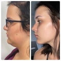 The Incredible Transformation: A Look at Kybella Before and After Photos