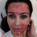 Everything You Need to Know About Vampire Facials