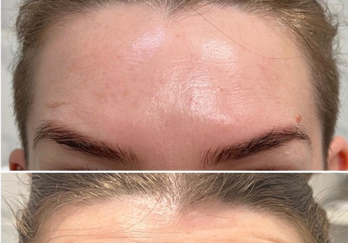 All You Need to Know About Botox Before and After Photos