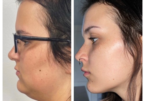 The Incredible Transformation: A Look at Kybella Before and After Photos