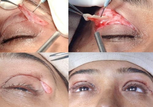 Everything You Need to Know About Eyelid Surgery