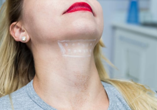 An Introduction to Kybella Treatment Process