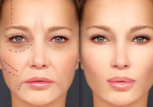 Dermal Fillers Before and After: What You Need to Know